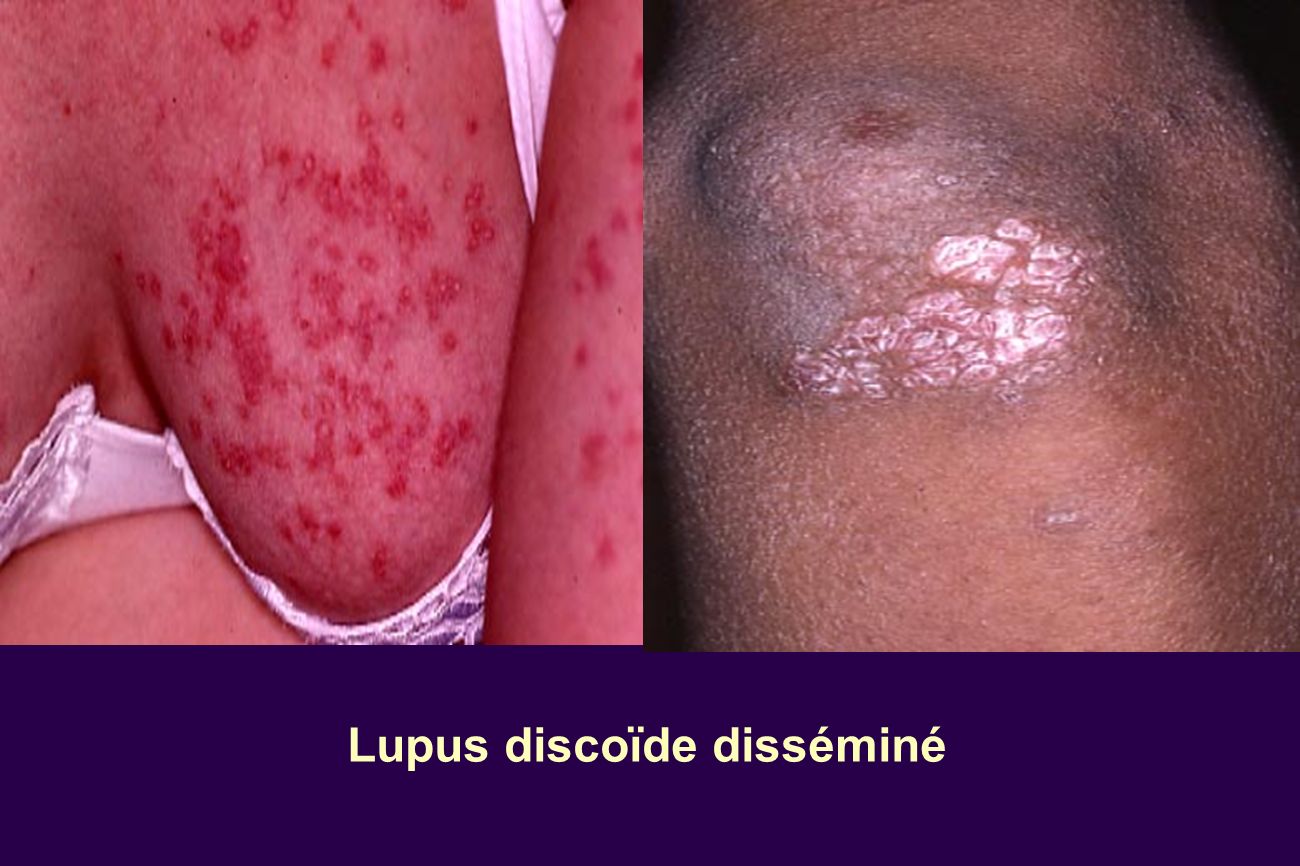 Lupus y engordar